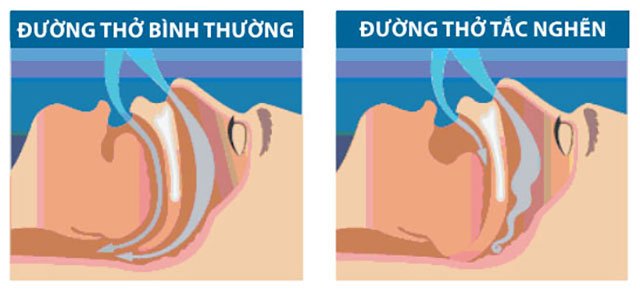 Hội chứng ngưng thở khi ngủ