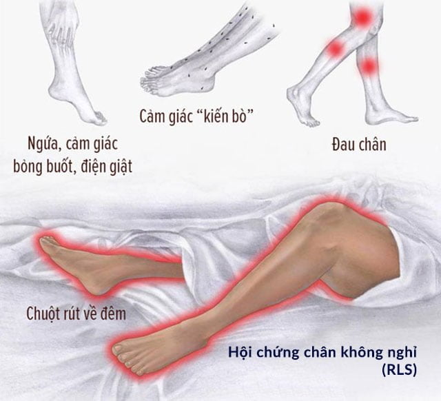 Hội chứng chân không nghỉ rls
