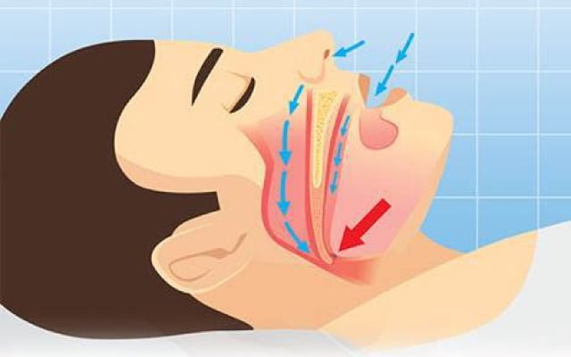 Nguyên nhân khiên bạn ngủ ngáy