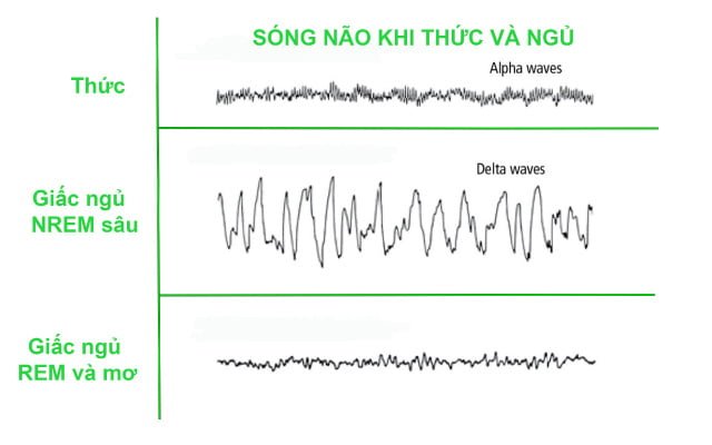 Đo sóng điện não khi ngủ