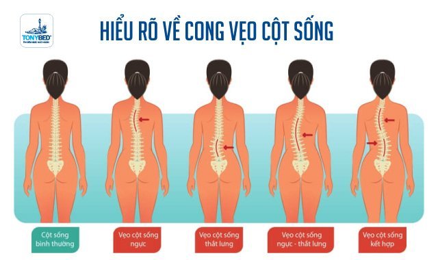 Bạn cần hiểu rõ về tình trạng vẹo cột sống của mình