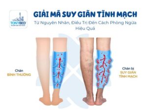 giai-ma-suy-giam-tinh-mach